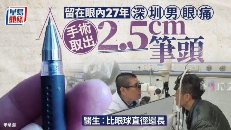 深圳男眼痛27年 手術驚見2.5厘米原子筆頭！竟是同學爭執時所留
