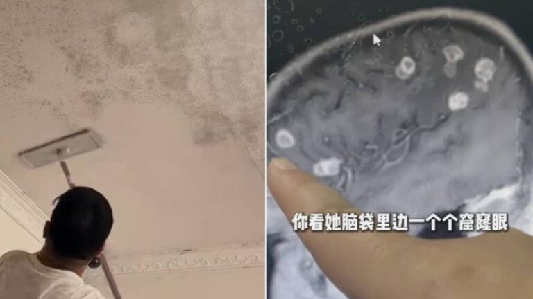 【恐怖個案】河南6歲女童大掃除後高燒17日 腦部竟被黴菌「啃出」逾20個坑洞！